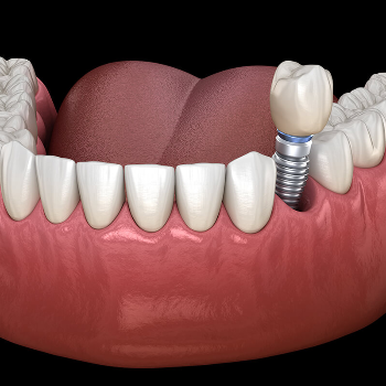 Transforming Smiles: The Power of Restorative Dentistry | Best Dental Clinic | Cdic smiles Wakad