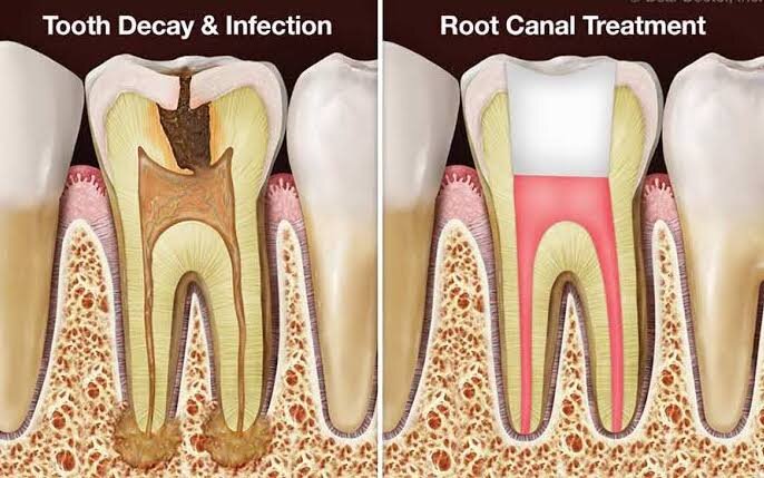 Transforming Smiles: How RCT Saved Meeta’s Dental Health | MODERN ORAL AND DENTAL CLINIC | Tenduni, Bikramganj, Rohtas
