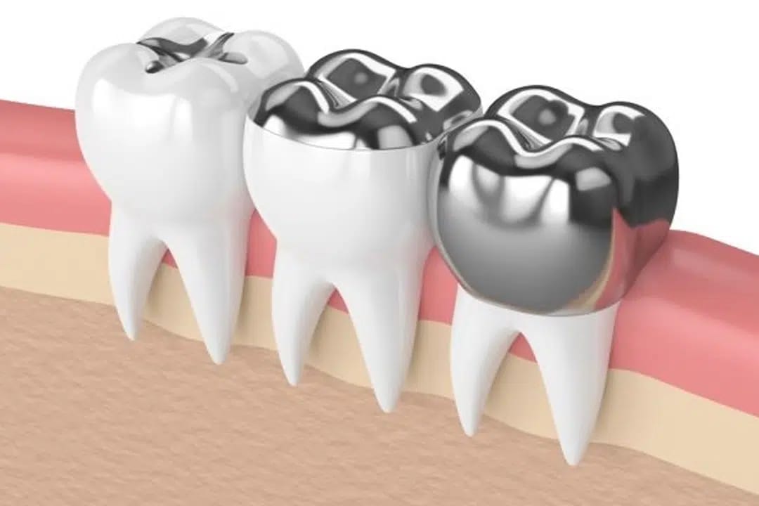 Transform Your Smile: How Teeth Capping Can Change Your Life | Sapphire Dental Orthodontic and Implant Centre