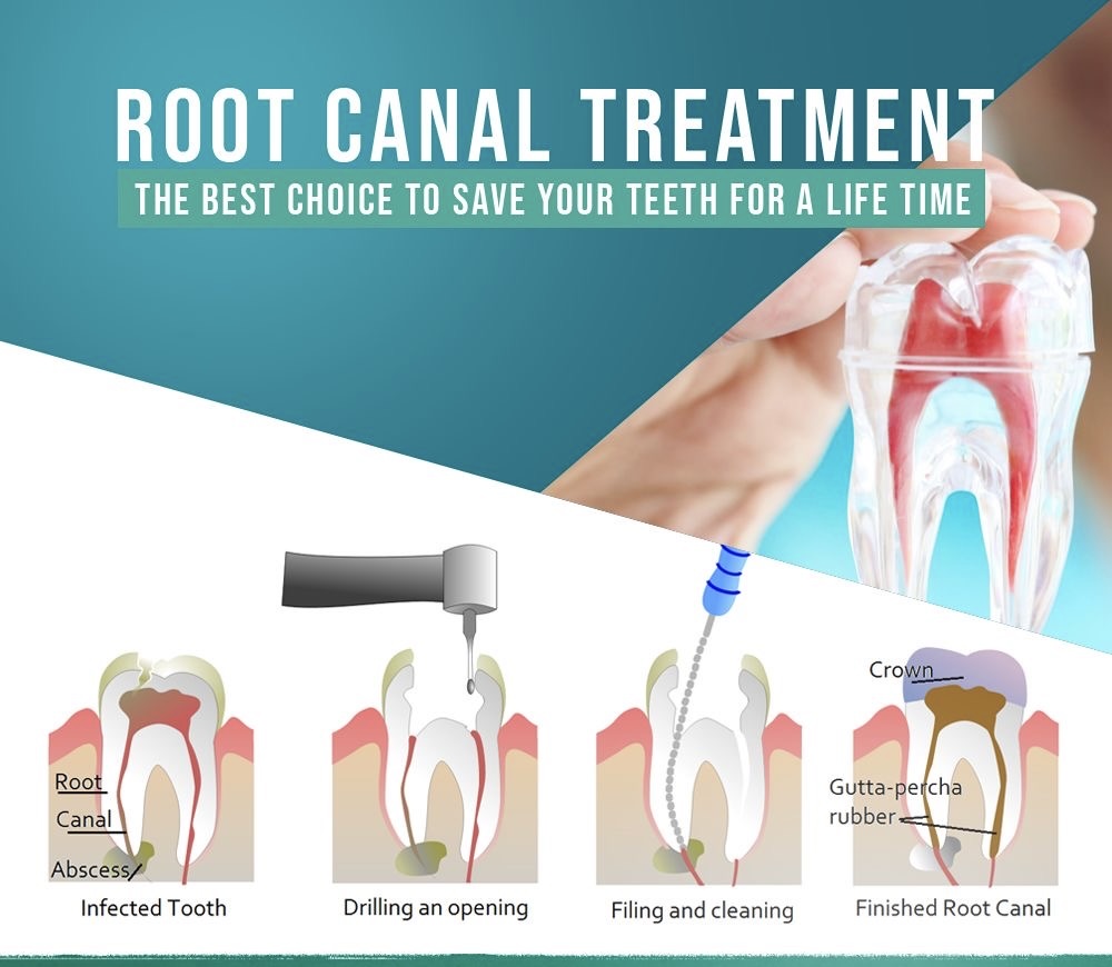Transforming Smiles and Lives: The Root Canal Revolution at Apple Dental Clinic | Aditya dental clinic