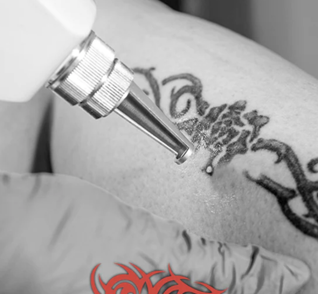 A Fresh Start: Transforming Lives with Tattoo Removal Services | Black Monster Tattoo Studio