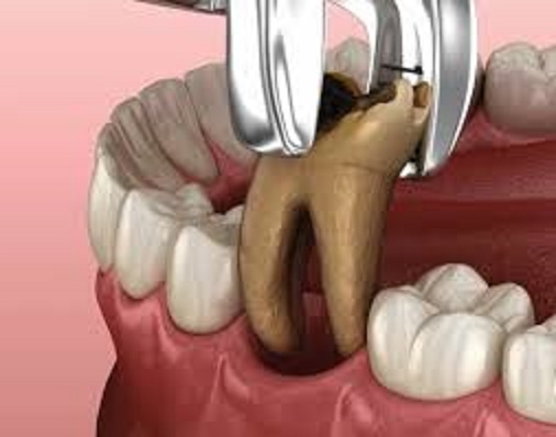A Pain-Free Journey: How Modern Oral and Dental Clinic Transforms Tooth Extraction Experience | MODERN ORAL AND DENTAL CLINIC