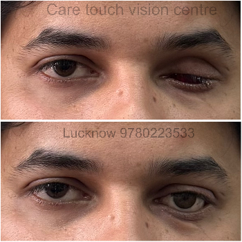Finding Confidence: How Artificial Eyes Transformed Meera’s World | CARE TOUCH VISION CENTRE