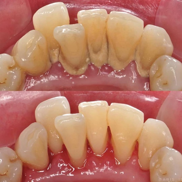 Transform Your Smile: How Scaling and Polishing Can Change Your Life | MODERN ORAL AND DENTAL CLINIC