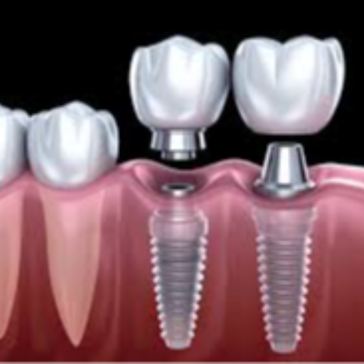 DENTAL IMPLANT-https://media.vyaparify.com/vcards/products/402527/product_1762418345_690c5ea97512a.png Image
