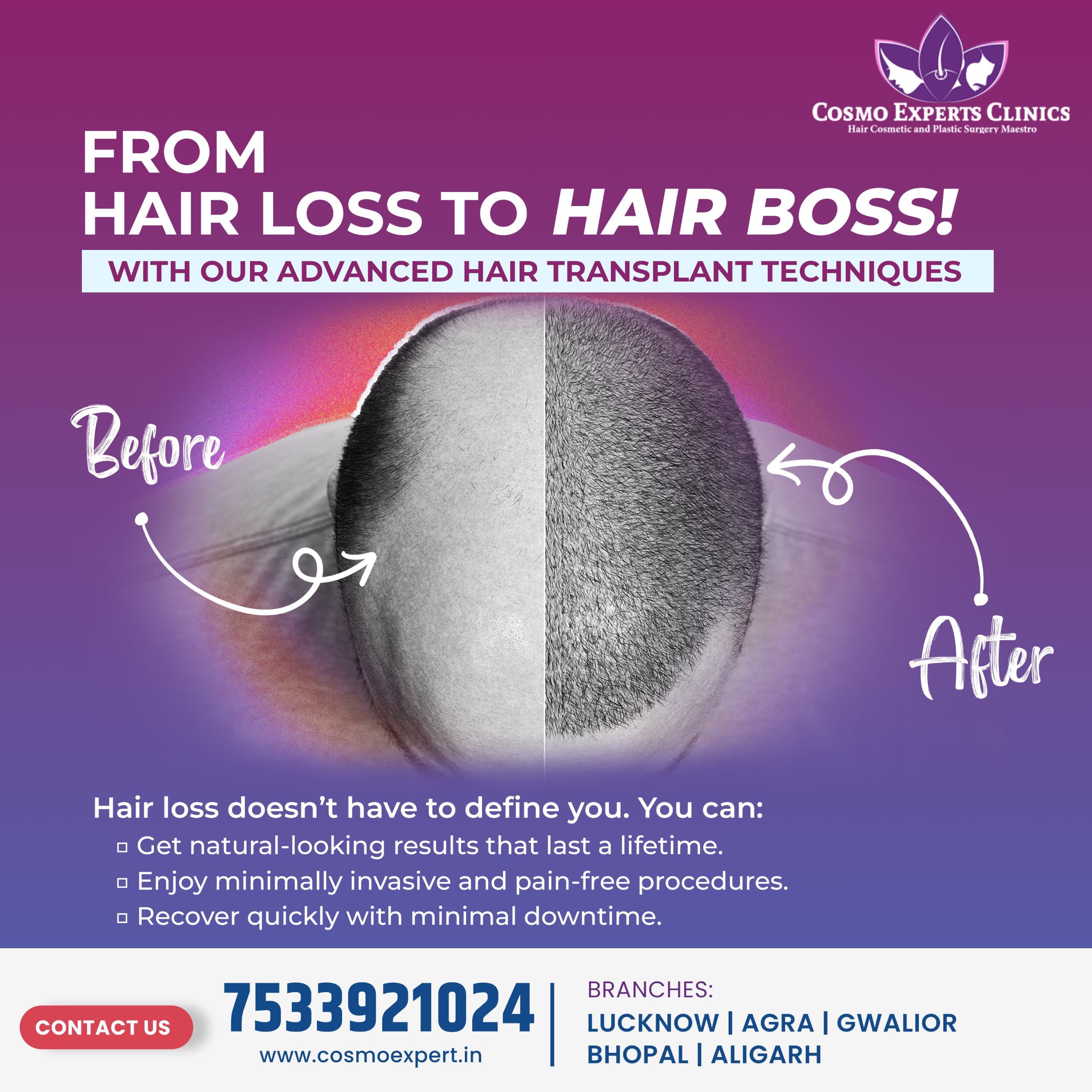 Hair Transplant Techniques in Agra: Advanced Solutions-https://media.vyaparify.com/vcards/products/465844/product_1766463620_694a18844f6e0.png Image