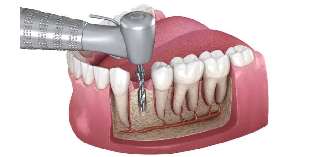  Dental/Root Canal Treatment in indore Precision Relief DR DAGLIAS SAMBHAV CLINIC 576 4 M G ROAD OPP  TI MALL BEHIND  PREMSHAN TIVILLA BUILDINGLANDMARK Behind Kalyan Jewellers MG Road