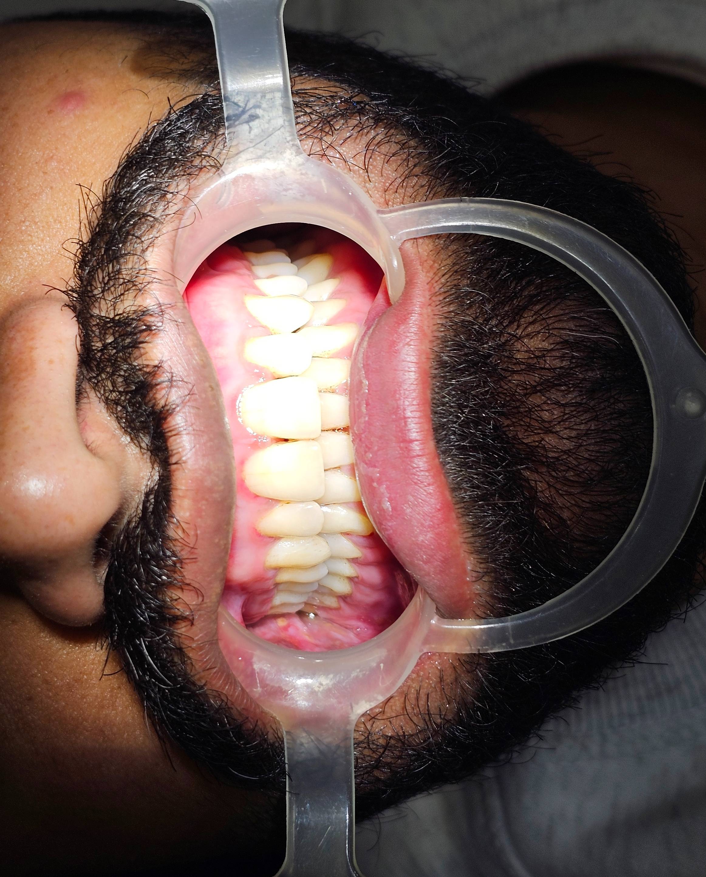 Dental Care: Teeth Scaling in Sanwer Road - Improve Oral Health-https://media.vyaparify.com/vcards/products/483106/product_1768128322_69637f4237fb7.png Image