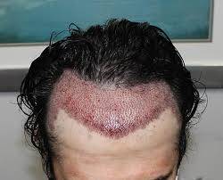 Hair Transplant Procedure in Agra: Grow Natural Hairs with Natural Hairline-https://media.vyaparify.com/vcards/products/489246/product_1768634614_696b38f636b76.png Image