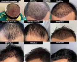Hair Transplant Procedure in Agra: Grow Natural Hairs with Natural Hairline-https://media.vyaparify.com/vcards/products/489247/product_1768634614_696b38f648667.png Image