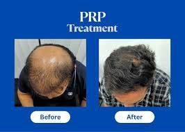 Hair Restoration PRP Treatment in Agra - Stimulates Natural Hair Growth-https://media.vyaparify.com/vcards/products/489249/product_1768634676_696b39347fc44.png Image
