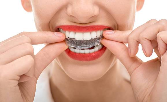 Dental Aligners: Invisible Teeth Aligners in Lucknow for Perfect Smile -  - Buy Online at AKHIL AGARWAL