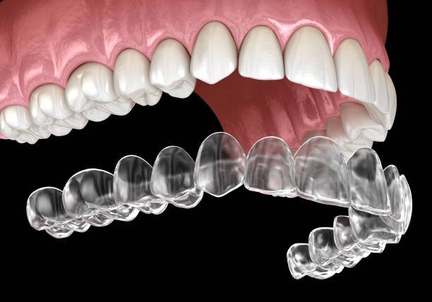 Dental Aligners: Invisible Teeth Aligners in Lucknow for Perfect Smile - Image 1