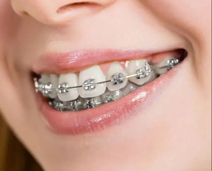 Orthodontist Metal Braces in Lucknow -  - Buy Online at AKHIL AGARWAL