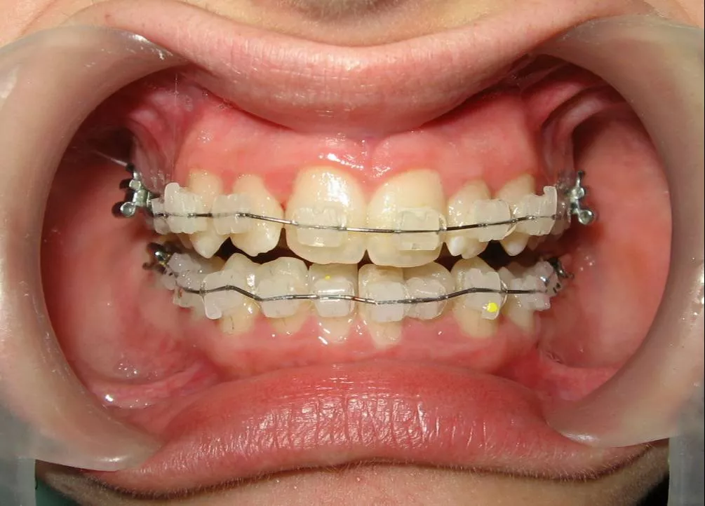 Orthodontist Ceramic Braces in Lucknow -  - Buy Online at AKHIL AGARWAL