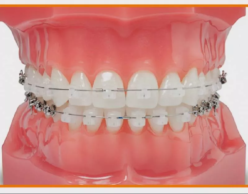 Orthodontic Self-Ligating Ceramic Braces in Lucknow - Faster Treatment -  - Buy Online at AKHIL AGARWAL