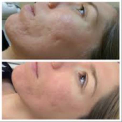 Fraction Treatment in Jhajjar | Skin Rejuvenation | IVAAN CLINIC | SHOP NO 160 SECTOR  06 MARKET JHAJJAR  LANDMARK NEAR SECTOR 6 Market