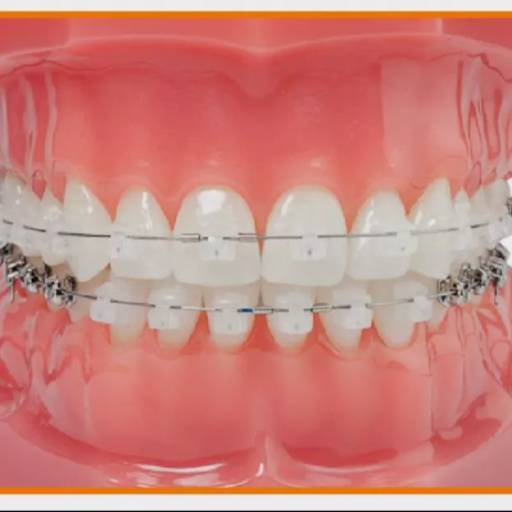 Ceramic Braces in Lucknow | Faster Treatment at AKHIL AGARWAL, LUCKNOW