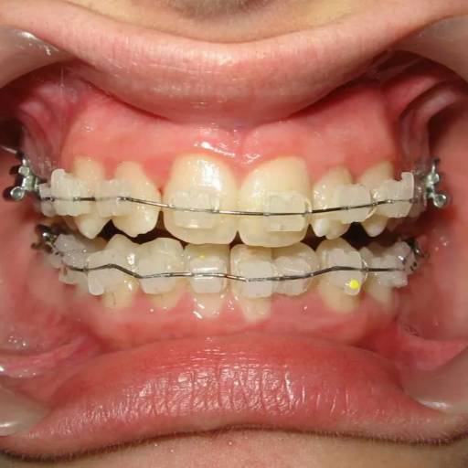 Ceramic Braces in Lucknow | Achieve a Perfect Smile at AKHIL AGARWAL, LUCKNOW