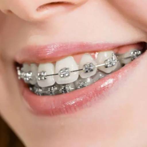Metal Braces in Lucknow | Effective Teeth Straightening at AKHIL AGARWAL, LUCKNOW