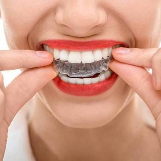 Invisible Teeth Aligners in Lucknow | Perfect Smile at AKHIL AGARWAL, LUCKNOW
