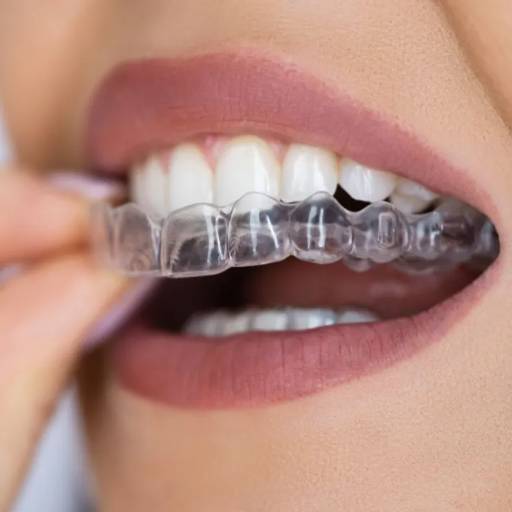 Aligners in Oro Dental Clinic | Discreet Teeth