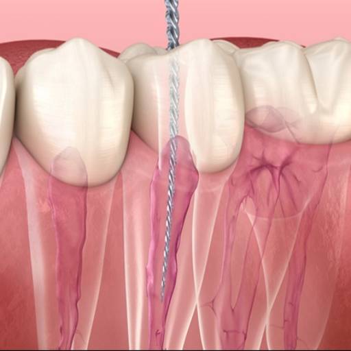 RISHABH RAMESH PENDURKAR - Root Canal in Mumbai | Save Your Natural Tooth in MUMBAI in MUMBAI